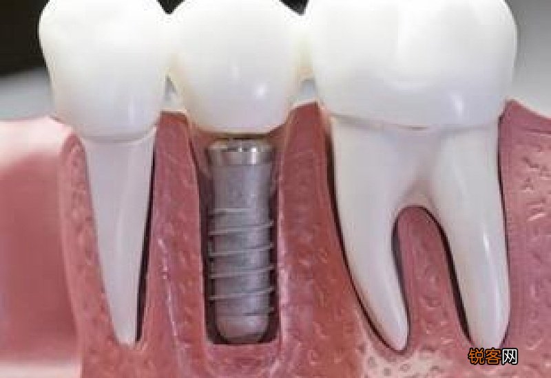 种植牙多少钱一颗效果怎么样