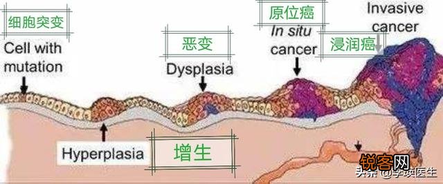 原位癌、微浸润癌、浸润癌有什么区别？