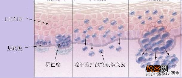 原位癌、微浸润癌、浸润癌有什么区别？