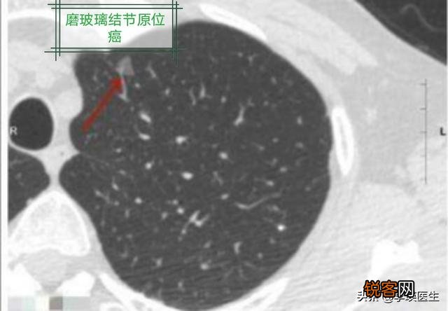 原位癌、微浸润癌、浸润癌有什么区别？