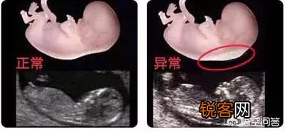大排畸以后,为什么还要再做至少2次B超?真的重要吗?