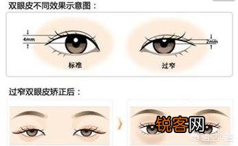 为什么有人割了双眼皮也不好看？