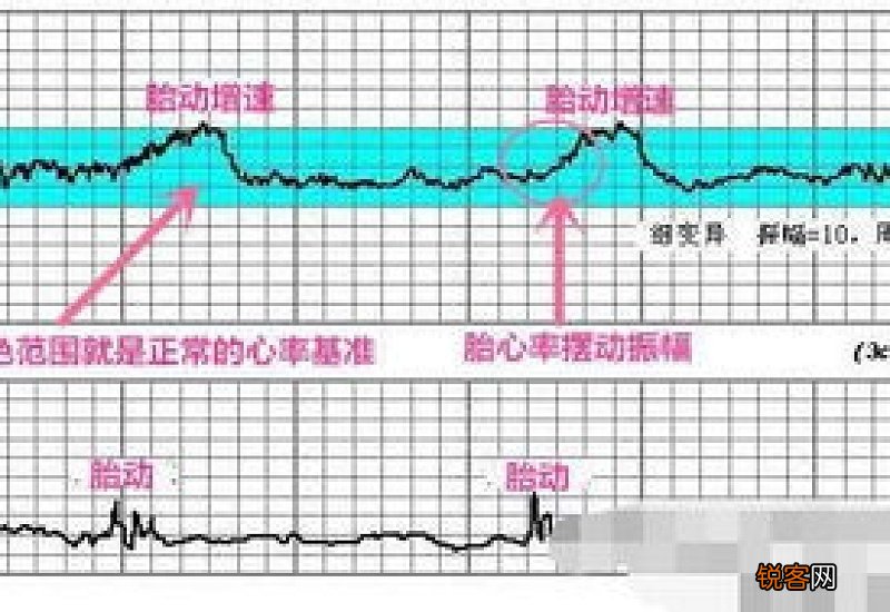 胎心监护图怎么看