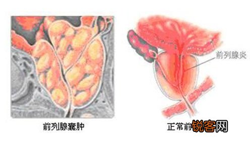 前列腺囊肿小心变成“大危害” 都分为哪些类型呢
