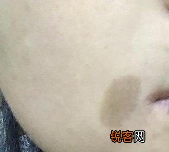脸上常见的斑有哪些 看看自己的斑是属于哪一种