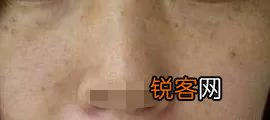 脸上常见的斑有哪些 看看自己的斑是属于哪一种