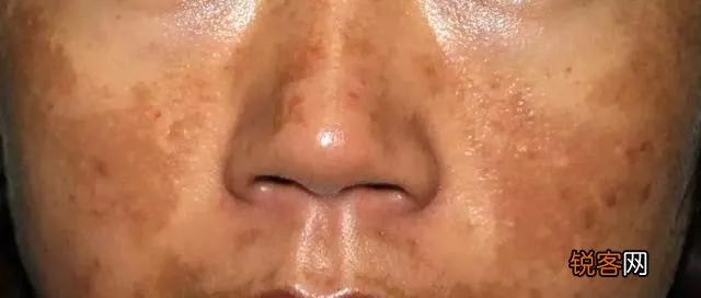 脸上常见的斑有哪些 看看自己的斑是属于哪一种