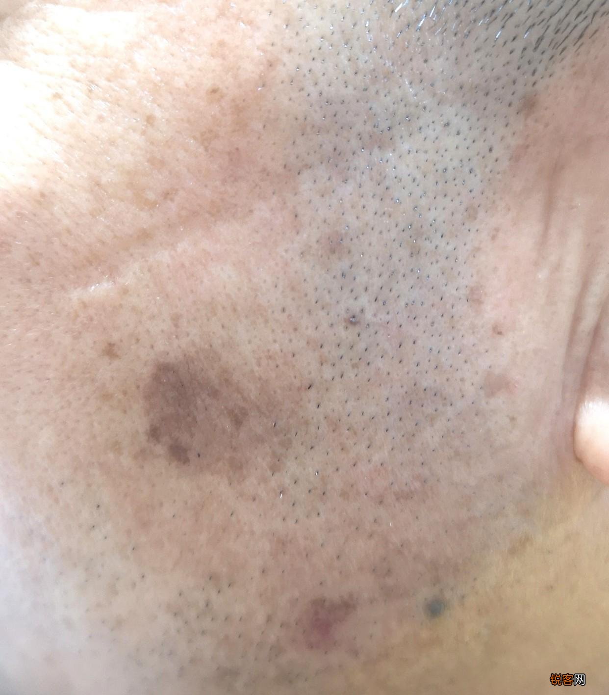 脸上常见的斑有哪些 看看自己的斑是属于哪一种