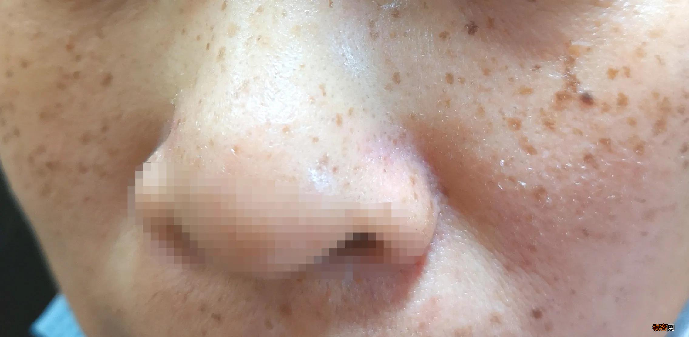 脸上常见的斑有哪些 看看自己的斑是属于哪一种