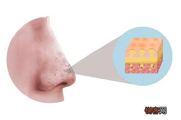 螨虫感染皮肤的症状 想要祛除尘螨怎么办