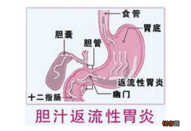 hp感染什么意思 胆汁反流性胃炎hp感染什么意思