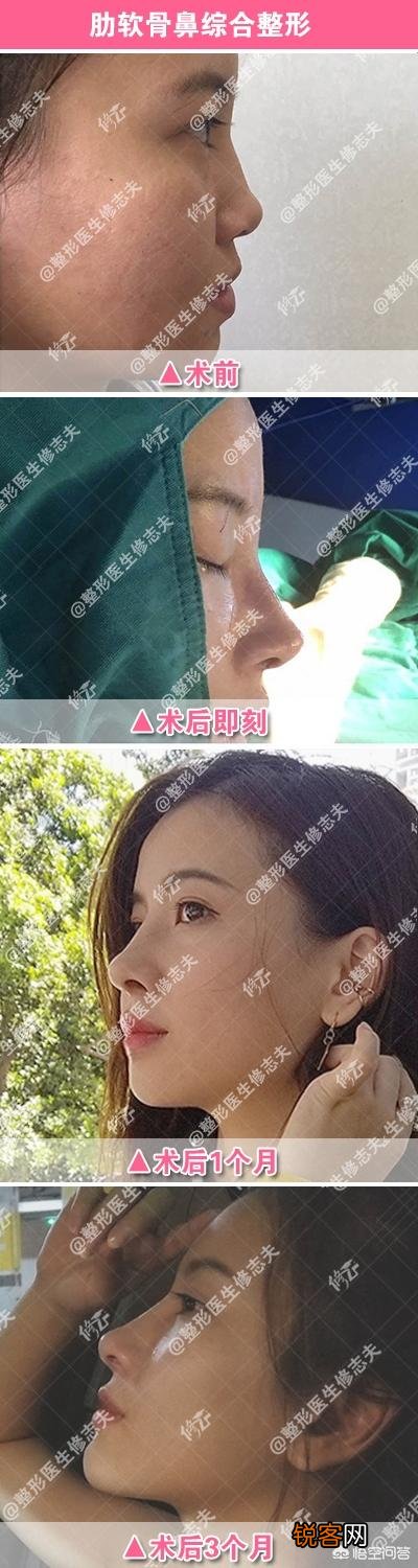 为什么很多女生正脸漂亮,侧脸却一般呢？