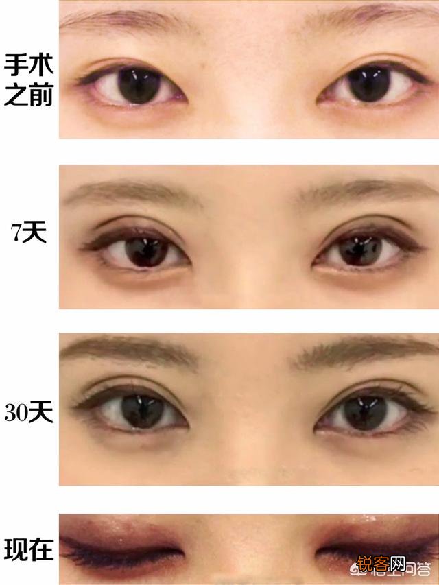 双眼皮有哪几种类型,如何选择适合自己的双眼皮类型？