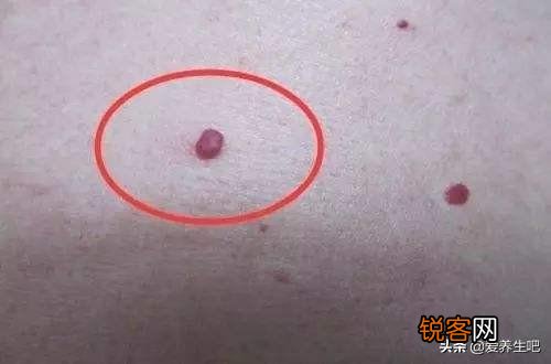 肝脏开始病变,会在身上长哪2种痣？在身体哪个部位？