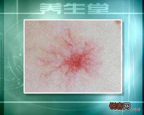 肝脏开始病变,会在身上长哪2种痣？在身体哪个部位？