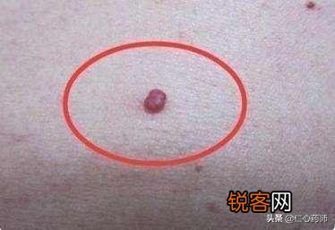 肝脏开始病变,会在身上长哪2种痣？在身体哪个部位？