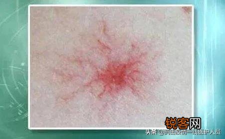 身体两处“变黑”,两处“长痣”,是肝脏病变预警,具体指的是哪些部位呢？