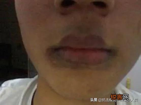 身体两处“变黑”,两处“长痣”,是肝脏病变预警,具体指的是哪些部位呢？