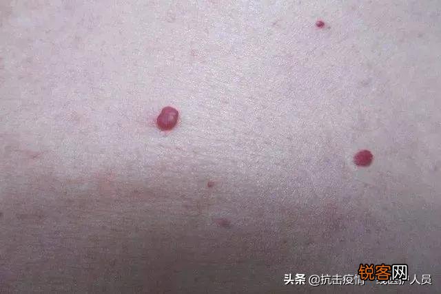 身体两处“变黑”,两处“长痣”,是肝脏病变预警,具体指的是哪些部位呢？