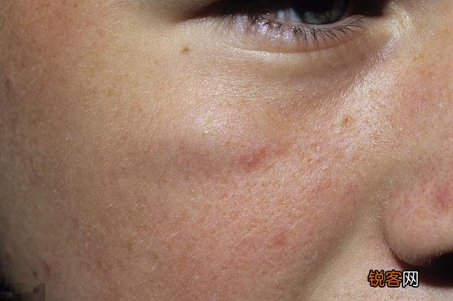 有人说一旦“脸上”有这3种表现,十有八九是“肝毒”太深了,指的是什么？