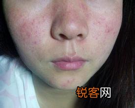 有人说一旦“脸上”有这3种表现,十有八九是“肝毒”太深了,指的是什么？