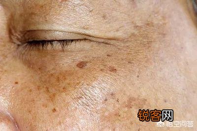 有人说一旦“脸上”有这3种表现,十有八九是“肝毒”太深了,指的是什么？