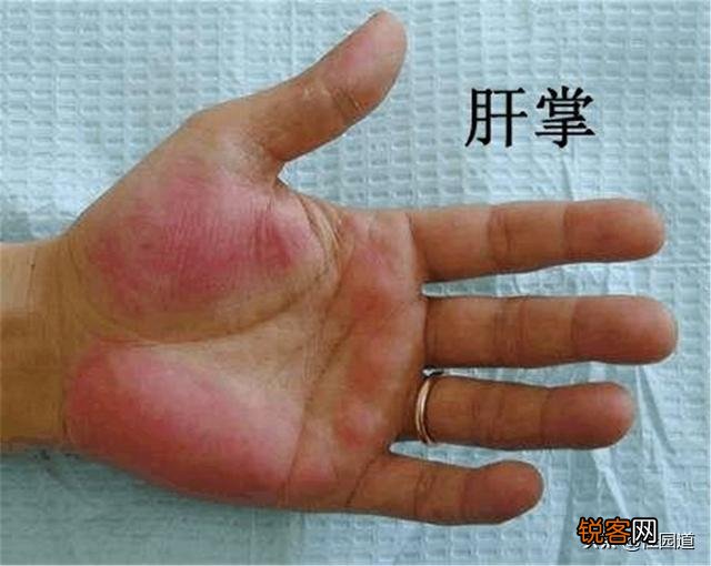 ?有人说肝不好的人,手上会出现“一处变细,二处发红,三处异常”,具体指的是什么？肝不好怎样养护？