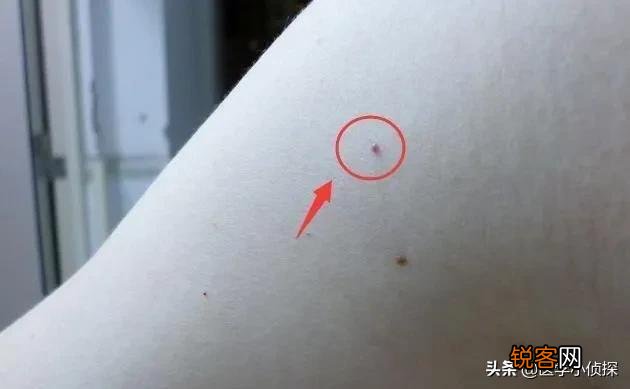 手上有小红点是什么原因？