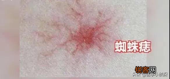 手上有小红点是什么原因？