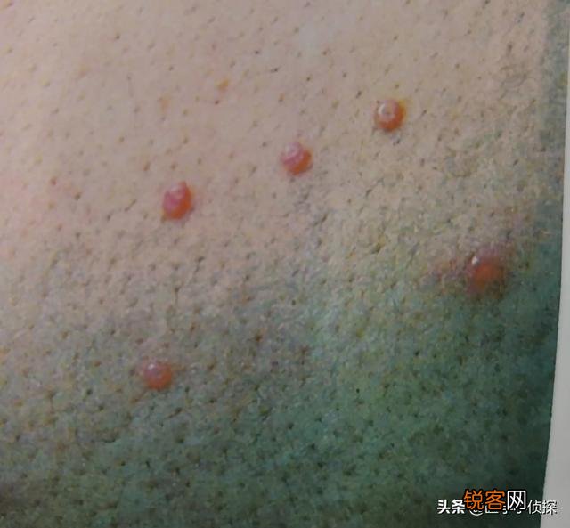 手上有小红点是什么原因？