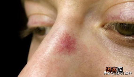 肝癌来临前,有人说会出现“1臭”,2“痛”,3“红”,是指什么？