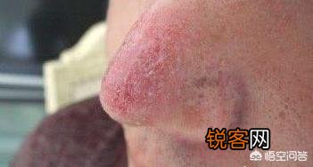 肝癌不是突然到来,有人说身体出现2臭、3痛、4红,已经提前通知了,指的是什么？