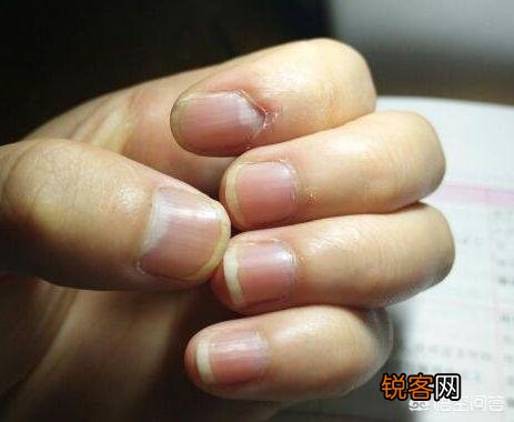 有人说,出现“两痣,三黄”,马上查查肝,警惕肝癌,指的是什么？