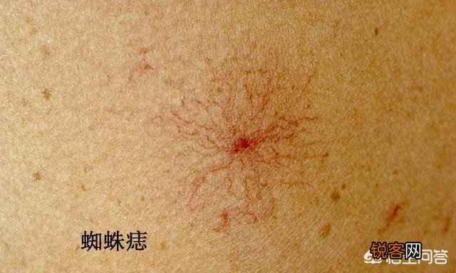 有人说,出现“两痣,三黄”,马上查查肝,警惕肝癌,指的是什么？