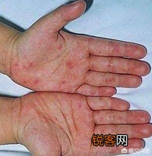 有人说,出现“两痣,三黄”,马上查查肝,警惕肝癌,指的是什么？