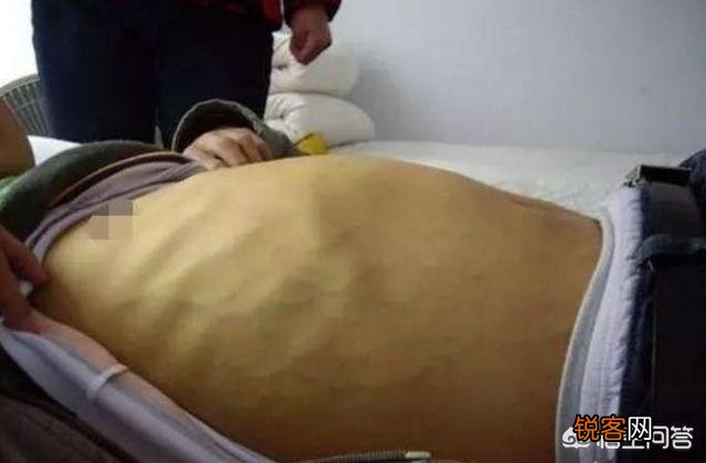 不管男女,身体出现这种“红痣”,说明你的肝脏病变了,究竟指的什么样的红痣？