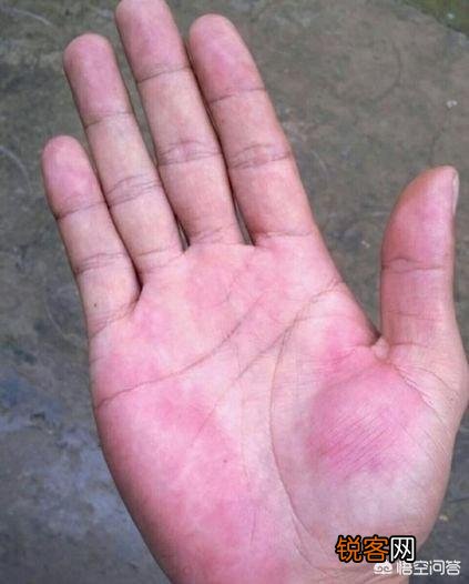 不管男女,身体出现这种“红痣”,说明你的肝脏病变了,究竟指的什么样的红痣？
