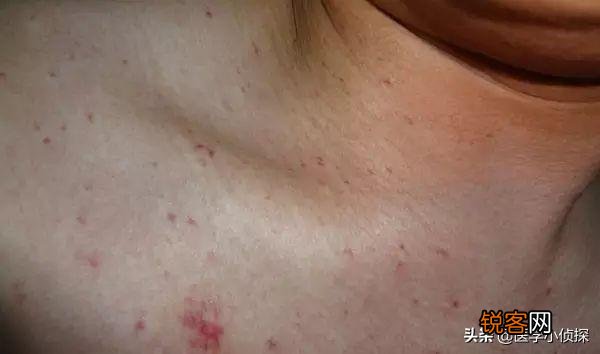 身上有小红痣,千万别大意,是大病的预警信号吗？