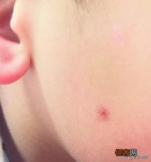 红痣究竟是不是变老、肝病的前兆？