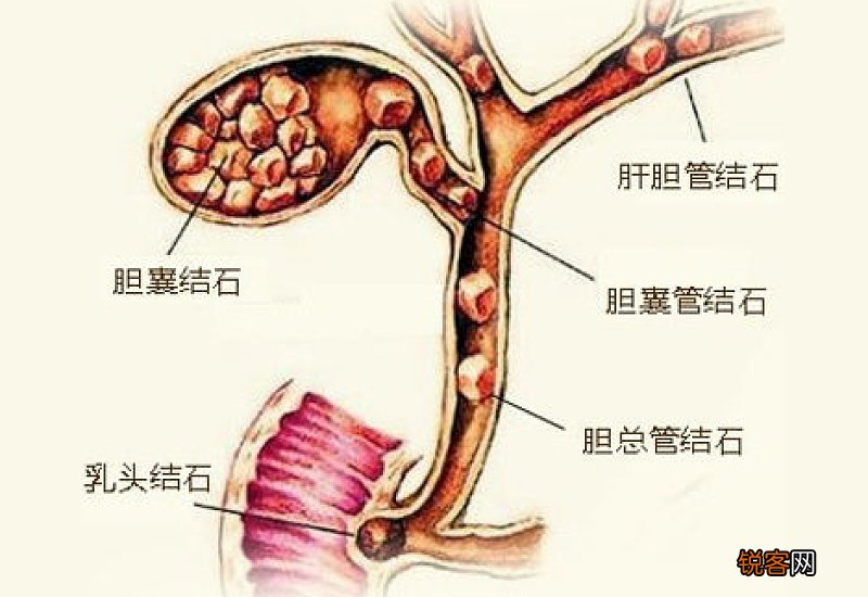 胆囊结石手术必须取胆吗