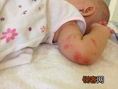 银屑病日常如何护理