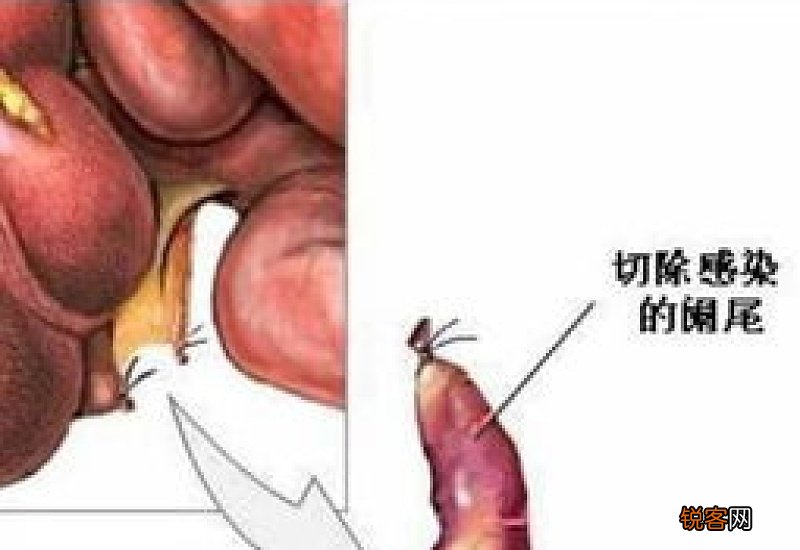 阑尾炎是怎么引起的呢 阑尾炎术后一般需要注意什么