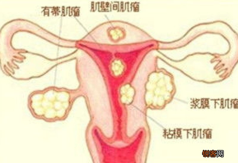 中医治疗子宫肌瘤是怎么样的 治疗子宫肌瘤的中药有哪些