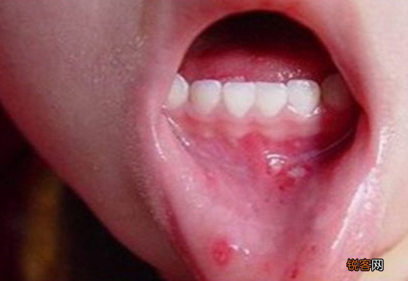 复发性口腔溃疡是什么原因 复发性口腔溃疡咋治