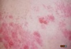 红斑狼疮吃什么食物好 红斑狼疮饮食吃什么好