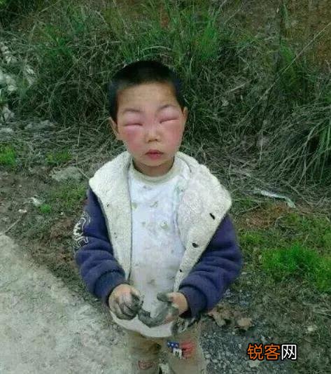 还记得小时候在农村屋檐下捅蜂窝,被蜜蜂蛰了的后果吗？