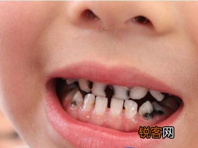 儿童牙齿变黑的原因是什么