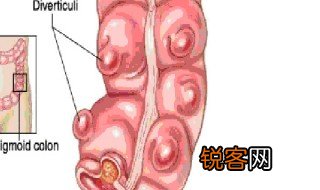 十二指肠降憩室什么意思 十二指降肠憩室的位置