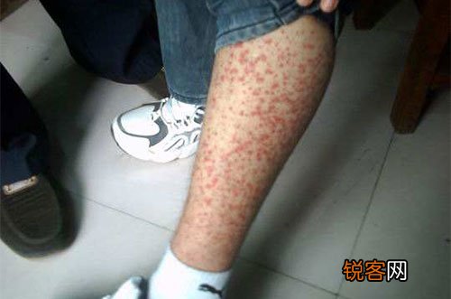 过敏性紫癜的危害究竟有多大？过敏性紫癜5个临床症状