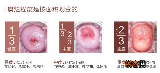宫颈腐败手术不克不及根治，女人该如何应对？